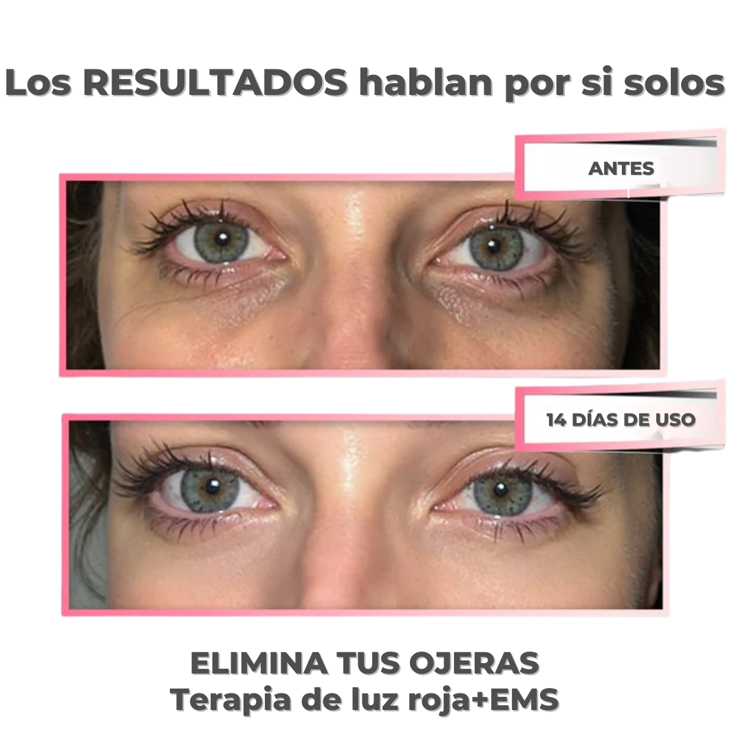 VitalEyes™ Terapia Luz Roja | Reduce Ojeras y Arrugas