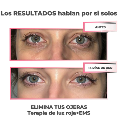 VitalEyes™ Terapia Luz Roja | Reduce Ojeras y Arrugas